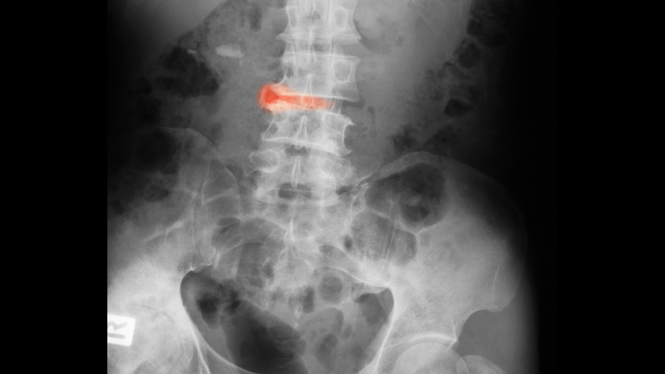 Sleep and Ankylosing Spondylitis Connection